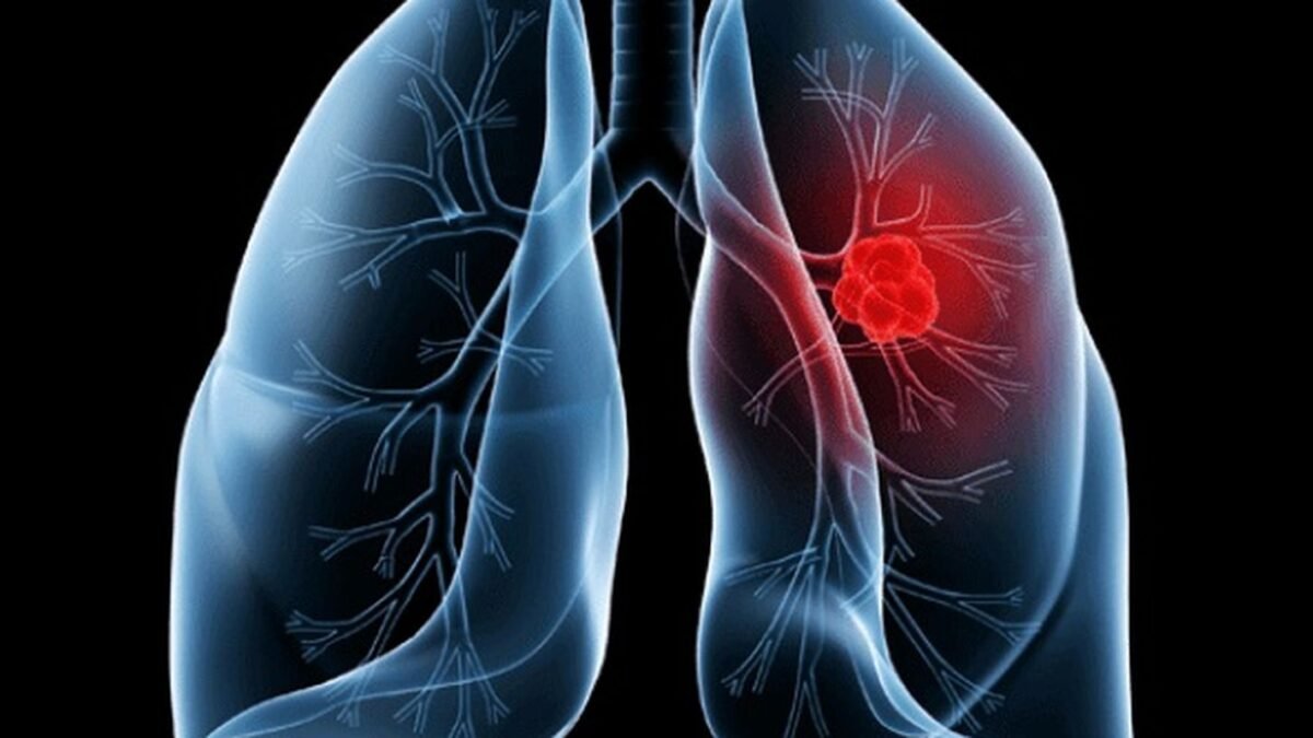 Saiba o que é adenocarcinoma pulmonar, câncer que atinge o Papa Leão XIV