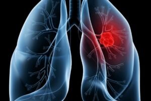 Saiba o que é adenocarcinoma pulmonar, câncer que atinge o Papa Leão XIV